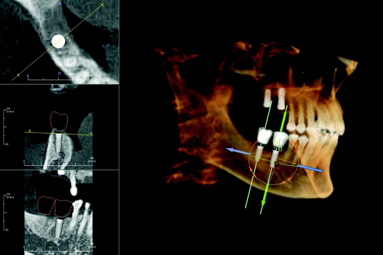 Implantologie – vysoce přesné implantační plány