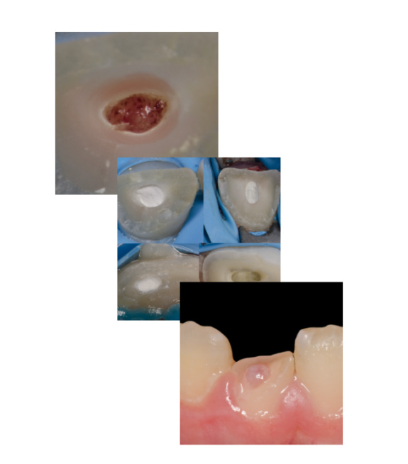 Endodontické ošetření zubů s nedokončeným vývojem
